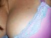 Zit on my Boobs