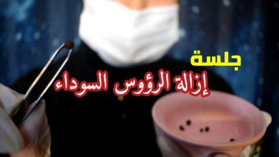 Arabic ASMR Blackhead Removal session  جلسة إزالة الرؤوس السوداء ● فيديو للاسترخاء والنوم
