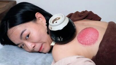 ASMR 630년 된 약초 불 부항 요법